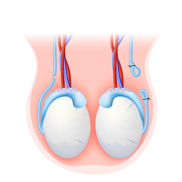 Vasectomia tem reversão?