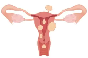 Miomatose uterina: o que é e relação com a infertilidade