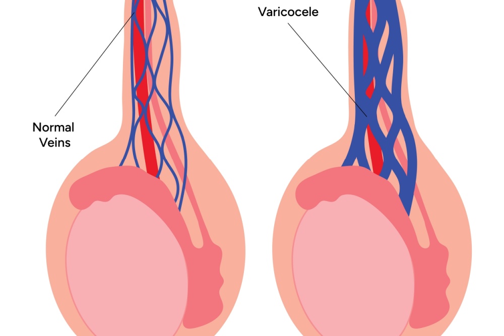 Quais as causas da varicocele?