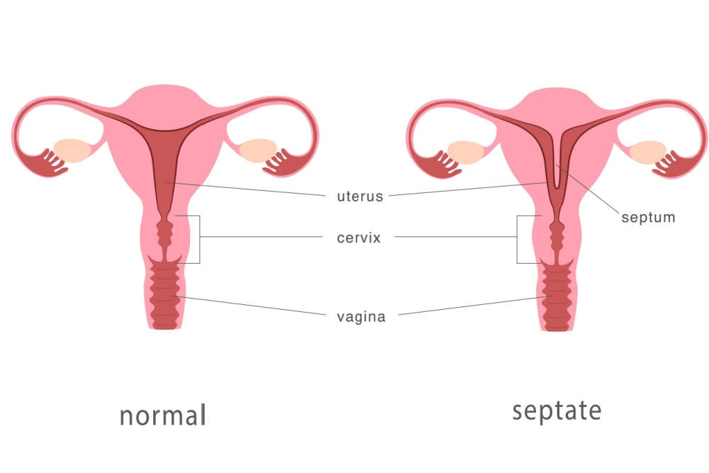 Útero septado: quem tem pode engravidar?