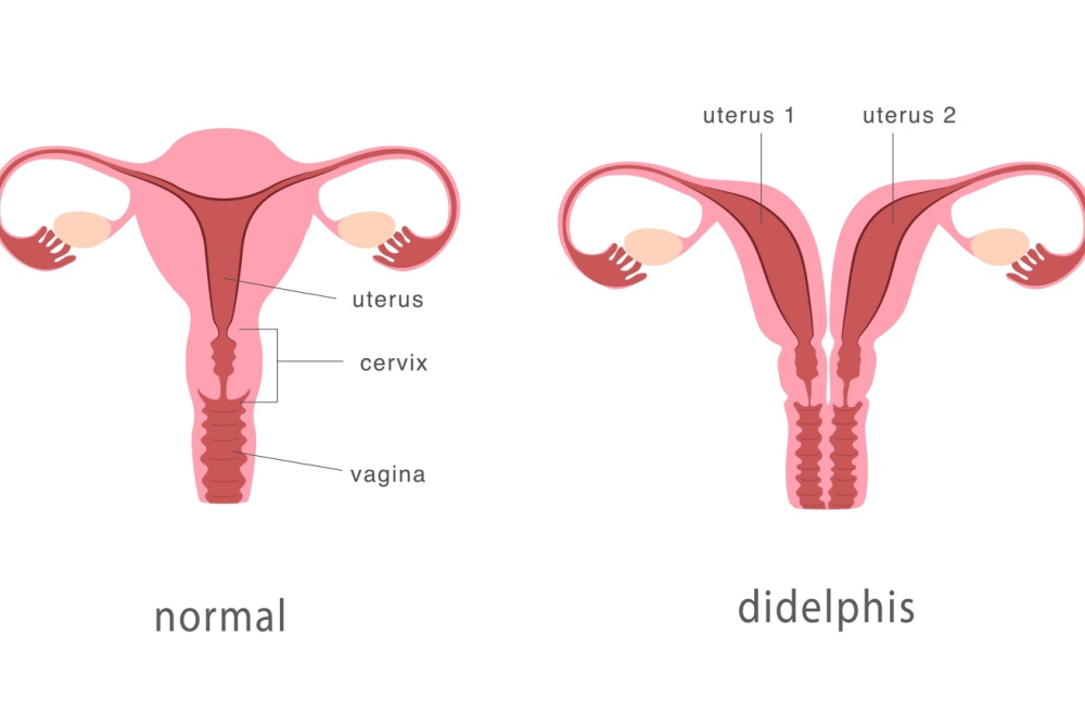Útero didelfo: quais os riscos dessa malformação?