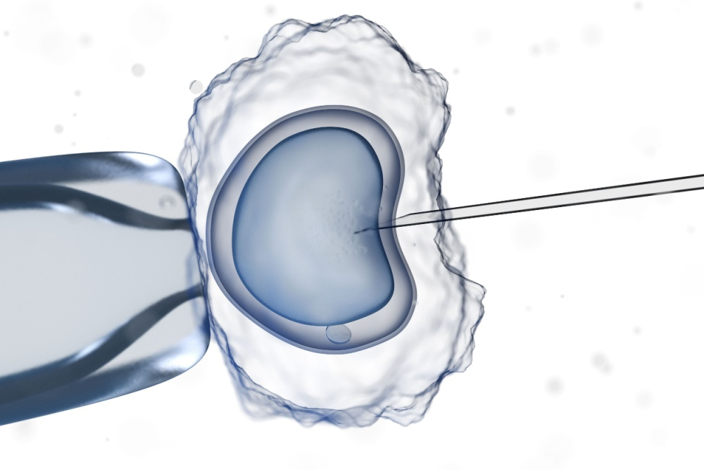 Quanto custa uma fiv com doação de óvulos?