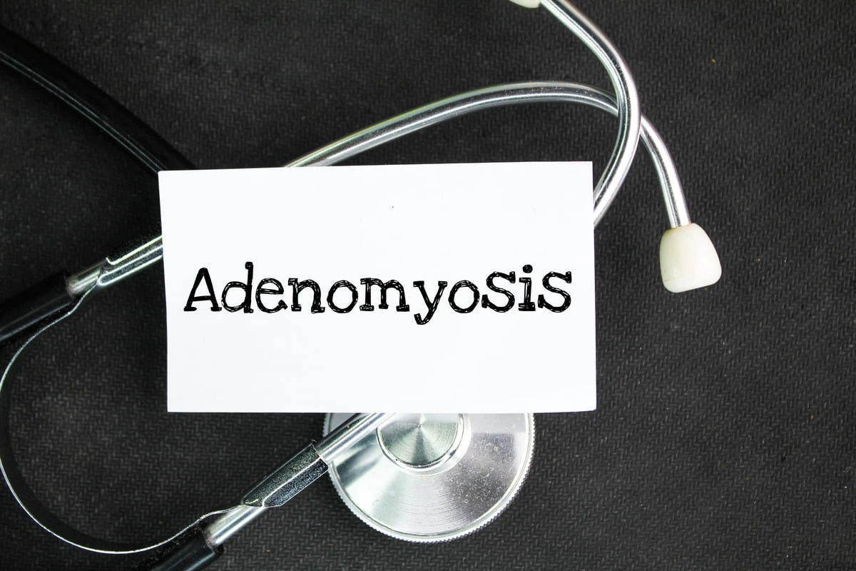 Adenomiose focal: sintomas, causas e tratamento
