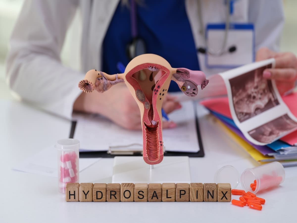O que é hidrossalpinge, causas e sintomas