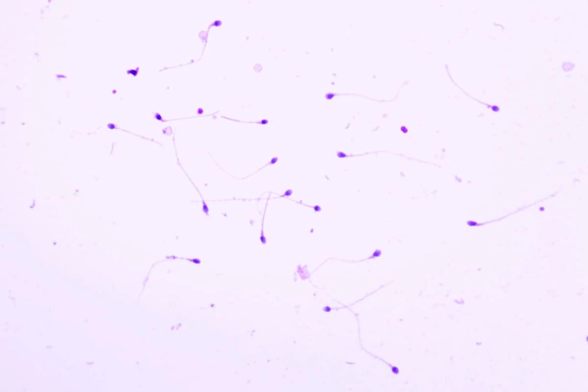 Como alterações morfológicas dos espermatozoides afetam a fertilidade masculina