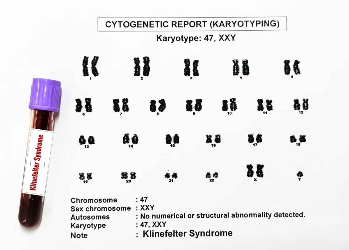 Síndrome de Klinefelter está associada à infertilidade?
