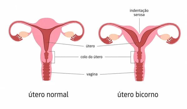 Útero bicorno e infertilidade: sintomas, diagnóstico e tratamentos